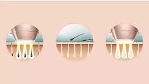 PHILIPS Lumea BRI956/00