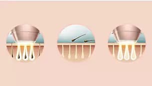 جهاز ليزر فيليبس لوميا PHILIPS Lumea BRI956/00 لازالة الشعر