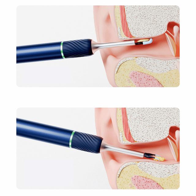 جهاز تنظيف الاذن اللاسلكي بيبيرد مع كاميرا Bebird Note 5 Pro Ear Wax Removal with Camera