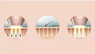 PHILIPS Lumea BRI956/00